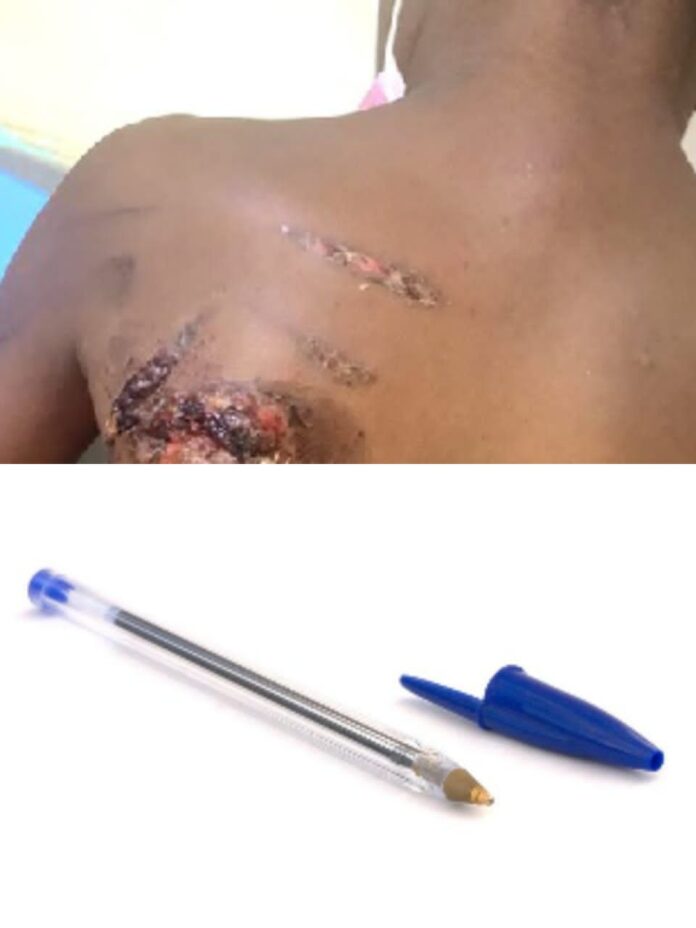 Mother remanded for allegedly burning 11-year-old son over lost pen